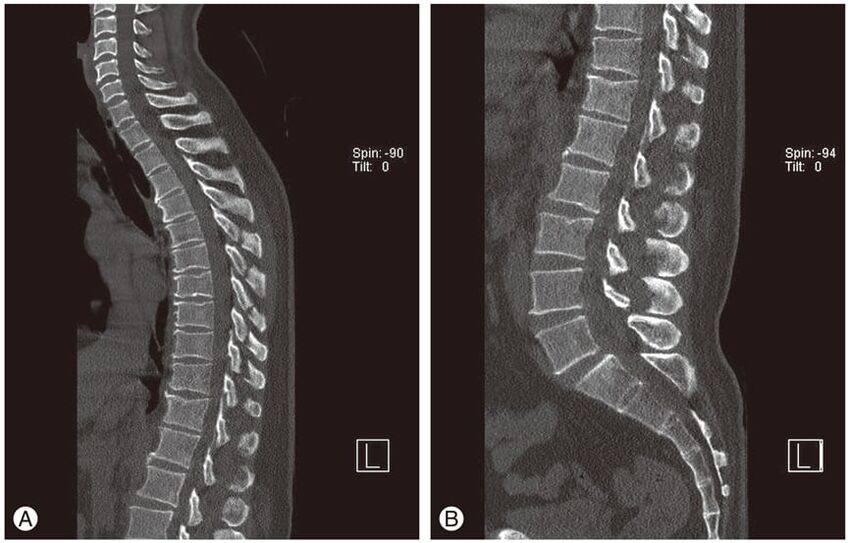 Deformacija medvretenčnih ploščic na MRI slikah pri torakalni osteohondrozi