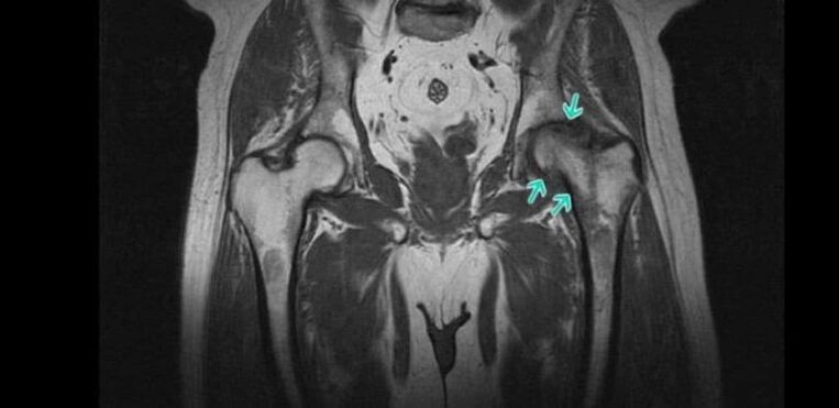 Osteoartritis kolčnega sklepa na MRI