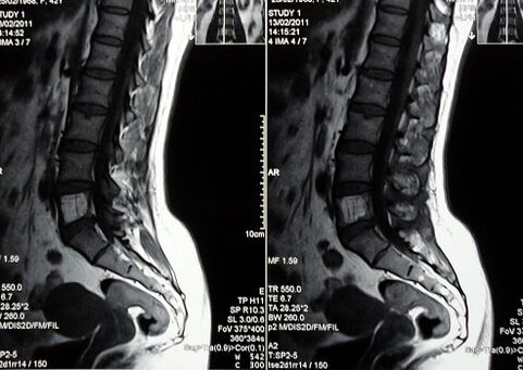 MRI lumbosakralne hrbtenice za diagnosticiranje bolečine v križu